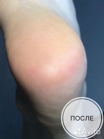 Педикюр аппаратный