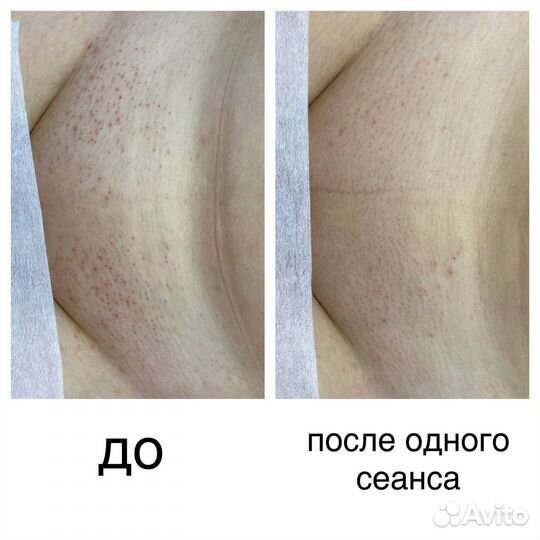 Лазерная эпиляция: глубокое бикини