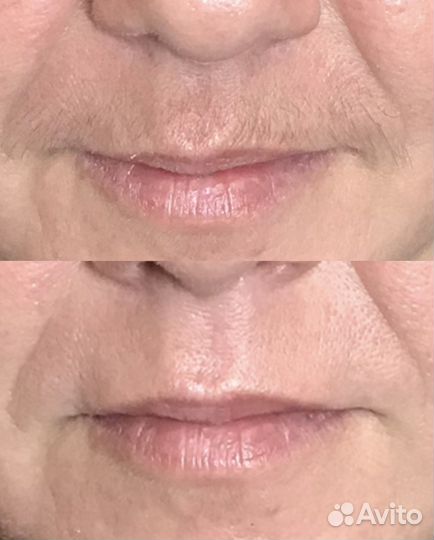 SPA-Шугаринг