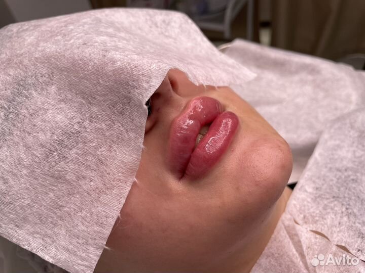 Модель на увеличение губ