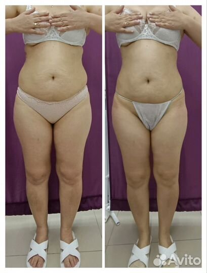 Аппаратно - вакуумный массаж Нижнекамск