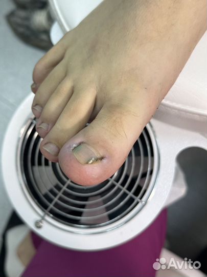 Вросший ноготь, бородавки, грибок ногтей