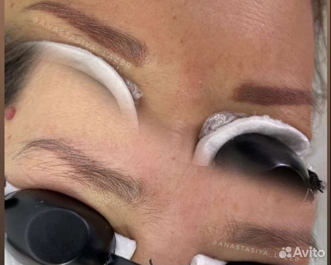 Удаление Тату/Татуажа лазером, карбоновый пилинг