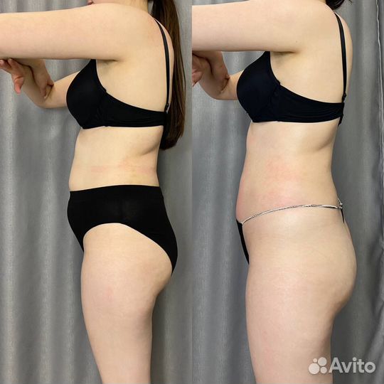 Аппаратный вакуумный массаж RF-лифтинг Кавитация