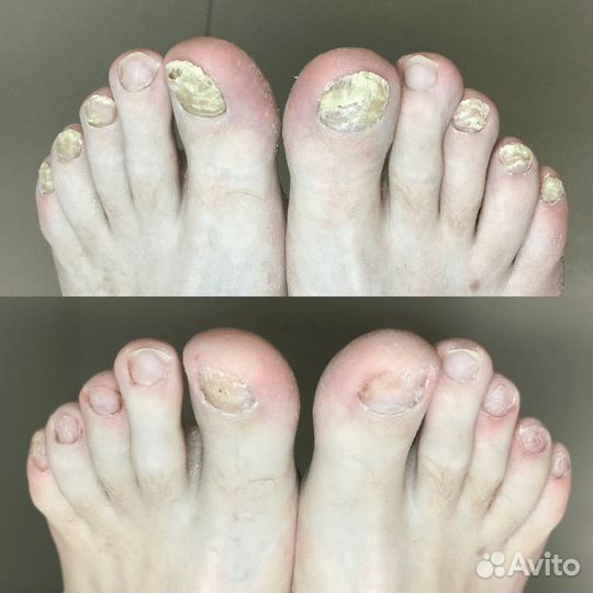 Подолог. Лечебный педикюр. Без боли