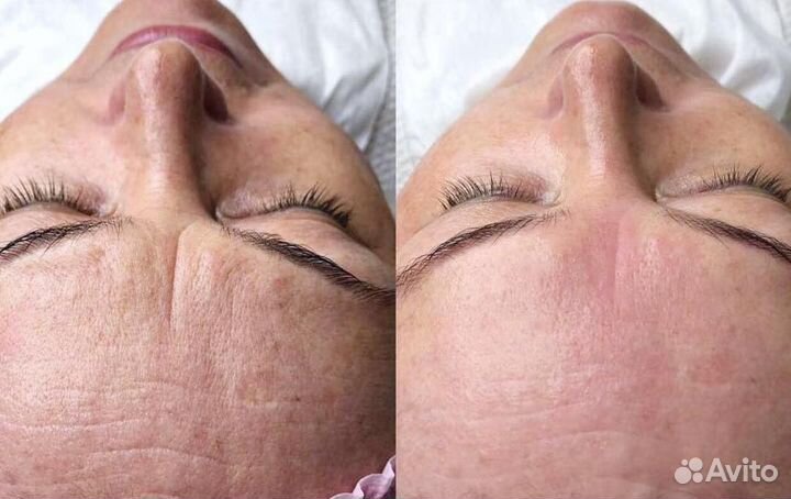 Модели Микроигольчатый RF-лифтинг