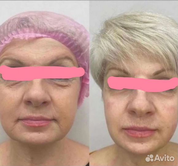 Микроигальчатый РФ лифтинг