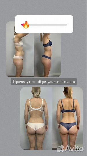 LPG, вакуумный, вибромассаж, антицеллюлитный