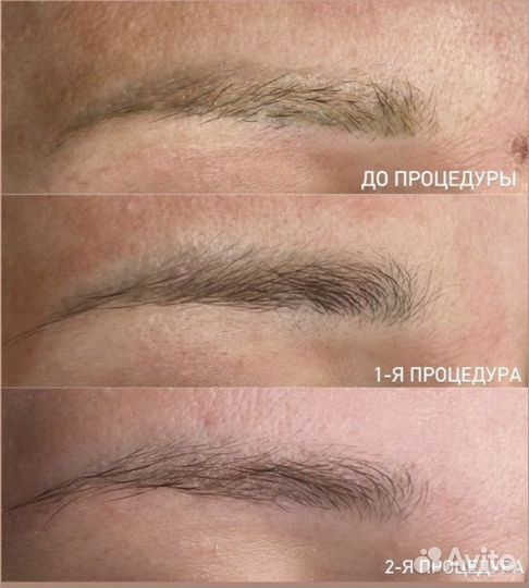 Удаление татуажа ремувером