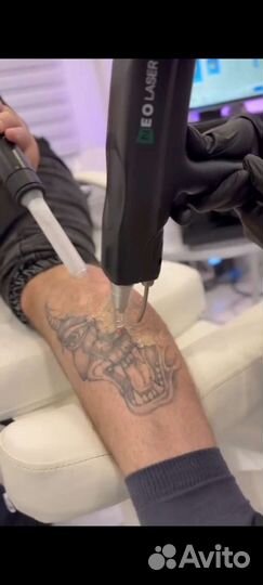 Удаление тату/ажа лазером