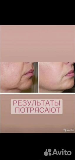 Смас-лифтинг лица
