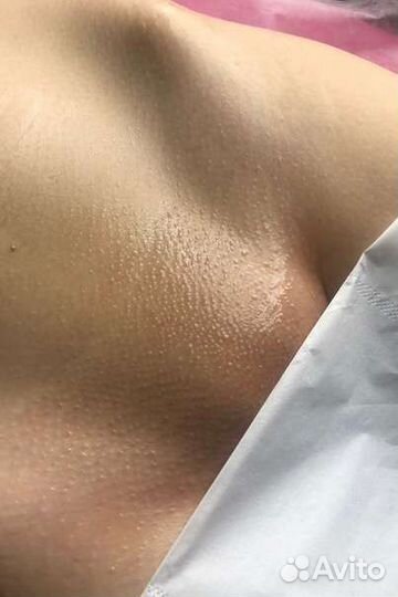 Депиляция