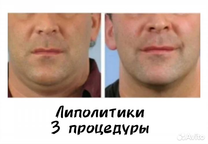 Удаление татуировок