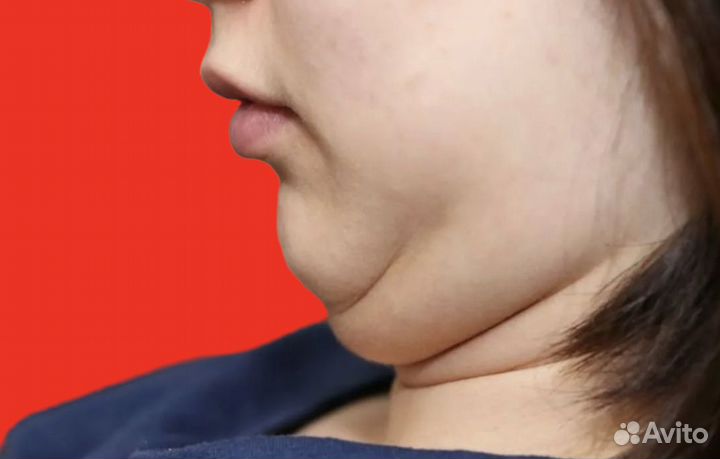 Модели на Удаление подбородка в салон 5 мест