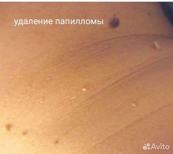 Удаление папиломм, шипиц, бородавок