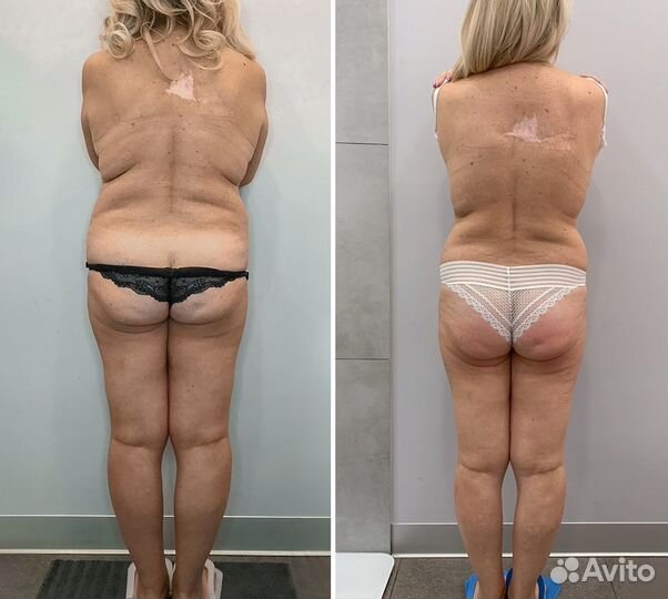 Коррекция фигуры безоперационная липосакция