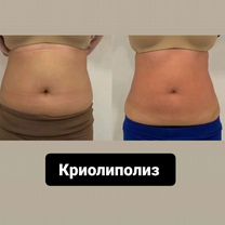 Криолиполиз похудение, Майкоп