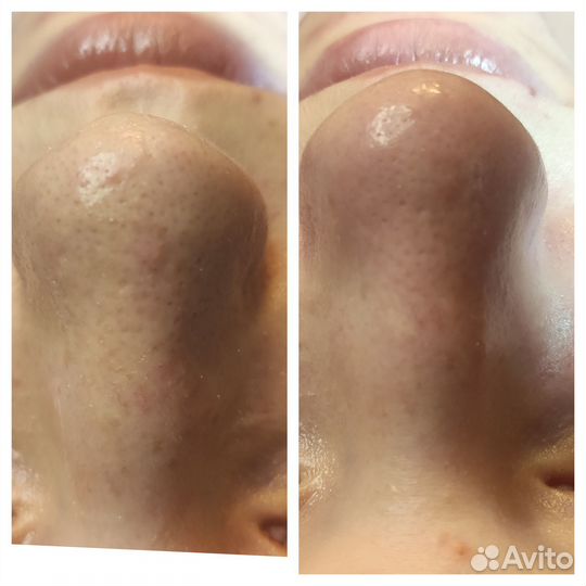 Косметолог чистка лица