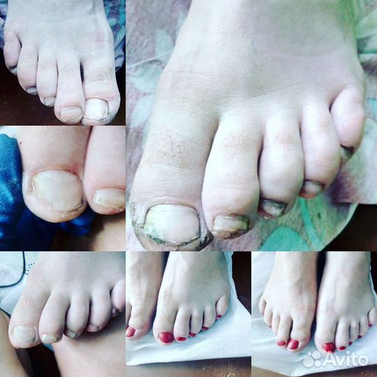 Препаратный педикюр