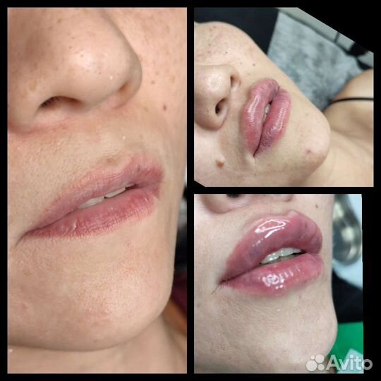 Увеличение губ топовые техники