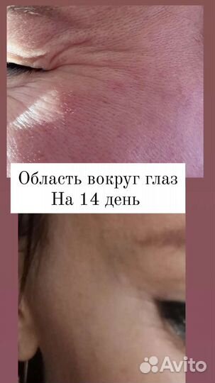 Ботокс, липолитики, мезотерапия, биоревитализация