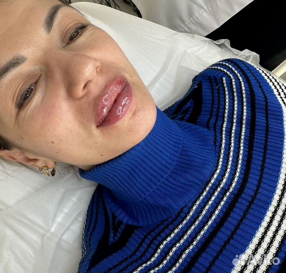 Увеличение губ / ботокс