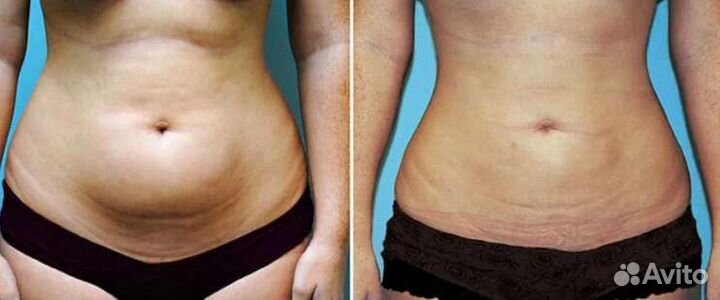 Липосакция, жиротоп и похудение Липосоникс