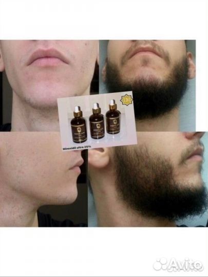 Миноксидил для роста волос и бороды