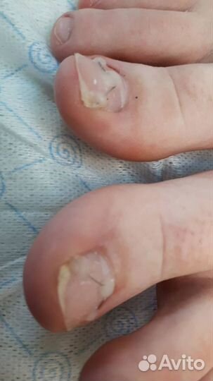 Медицинский педикюр, услуги подолога выезд на дом