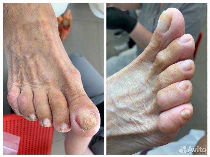 Лечебный педикюр подолог