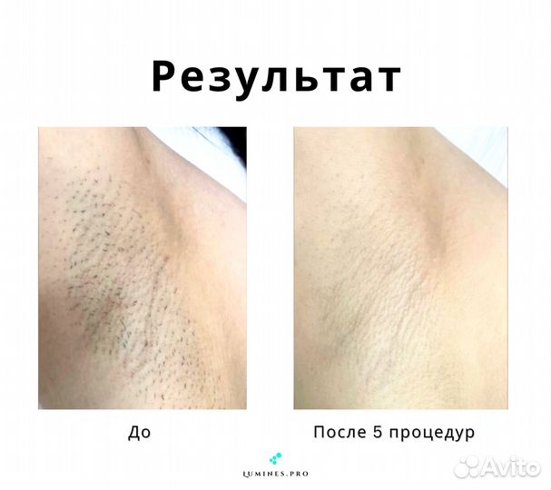 Диодный лазер для эпиляции Лю-Минес максван 1200в