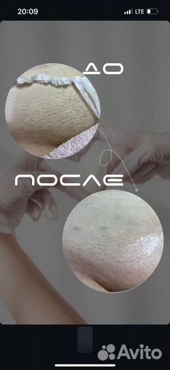 Электроэпиляция модель