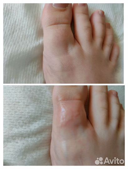 Электроэпиляция