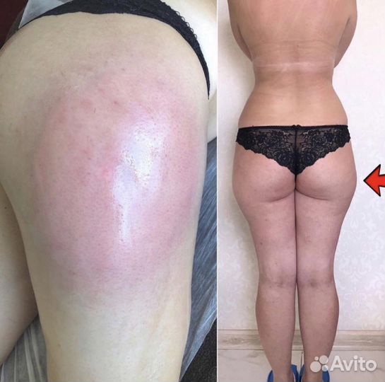 Массаж тела и лица / Ручная Липопластика