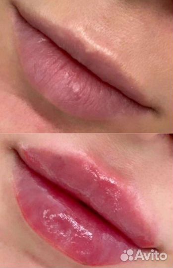 Увеличение губ