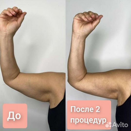 Аппаратный вакуумный массаж, кавитация, и др