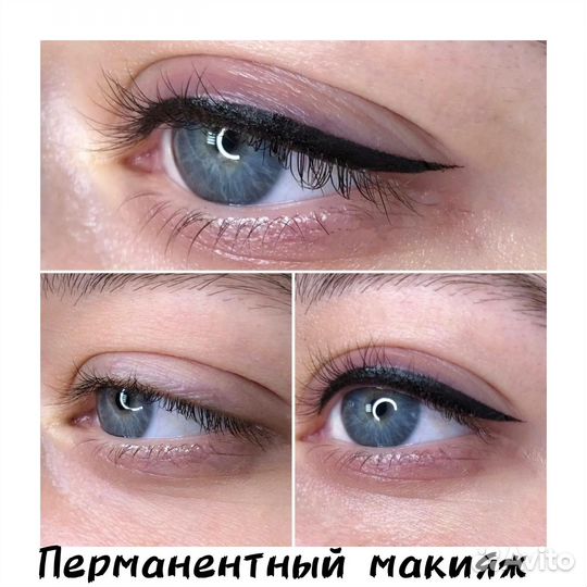 Удаление татуировок