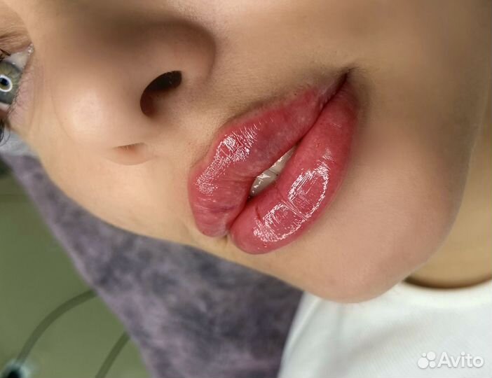 Увеличение губ, контурная пластика лица