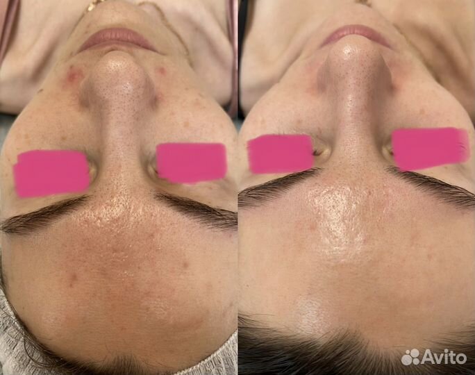 Чистка Лица Пилинг Массаж Микротоки