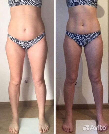 Антицеллюлитный массаж