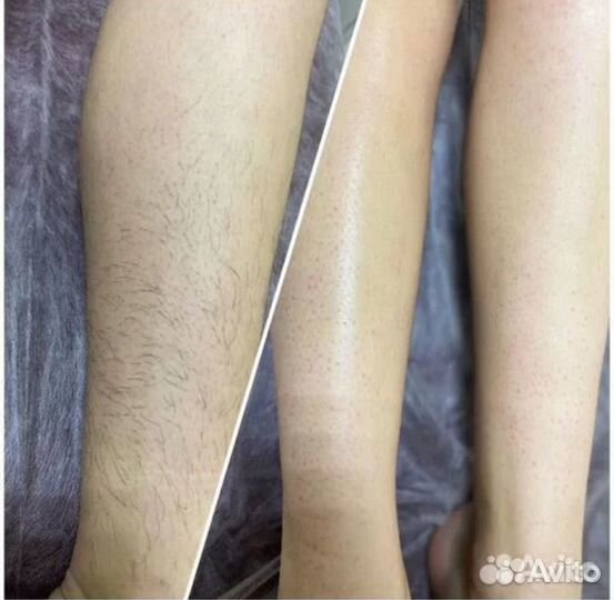 Шугаринг
