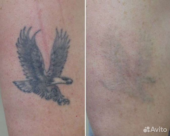 Удаление тату и татуажа. Требуются модели