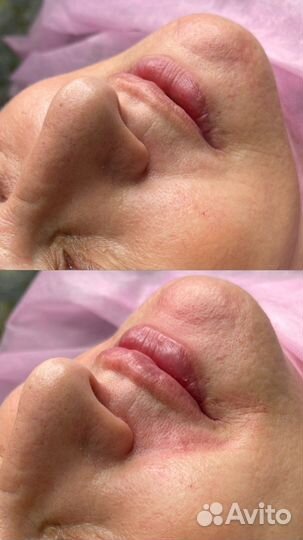 Увеличение губ