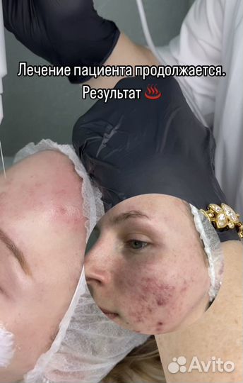 Удаление пигментных пятен,шрамов,рубцов