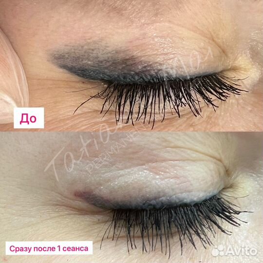 Удаление лазером татуажа и тату