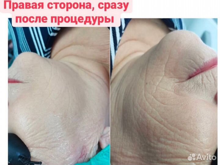 Лазерная эпиляция,фотоомоложение,rf лифтинг