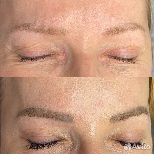 Удаление татуажа лазером