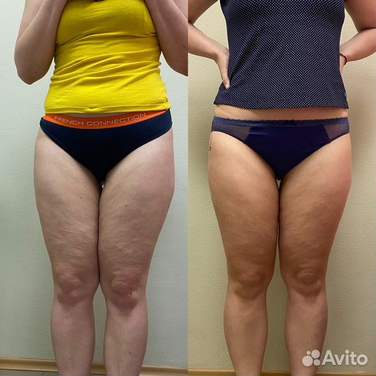 Аппаратный массаж / Криолиполиз / антицеллюлитный