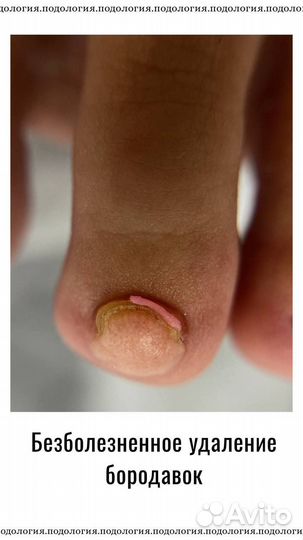 Подолог, вросший ноготь, титановая нить, педикюр