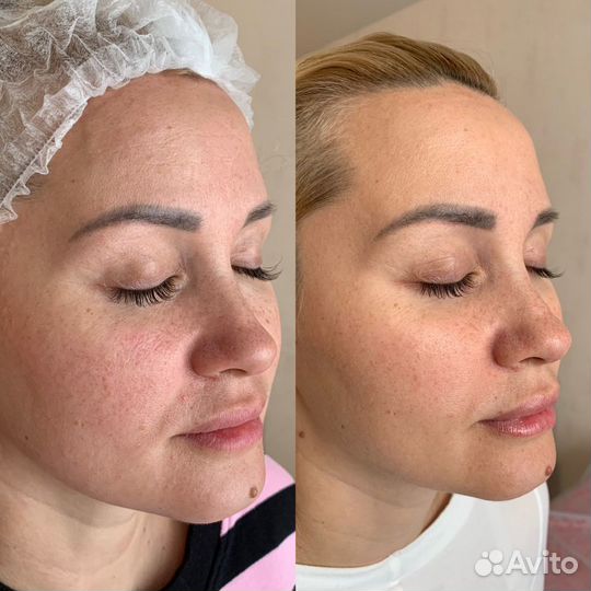 Smas лифтинг лица(подтяжка)